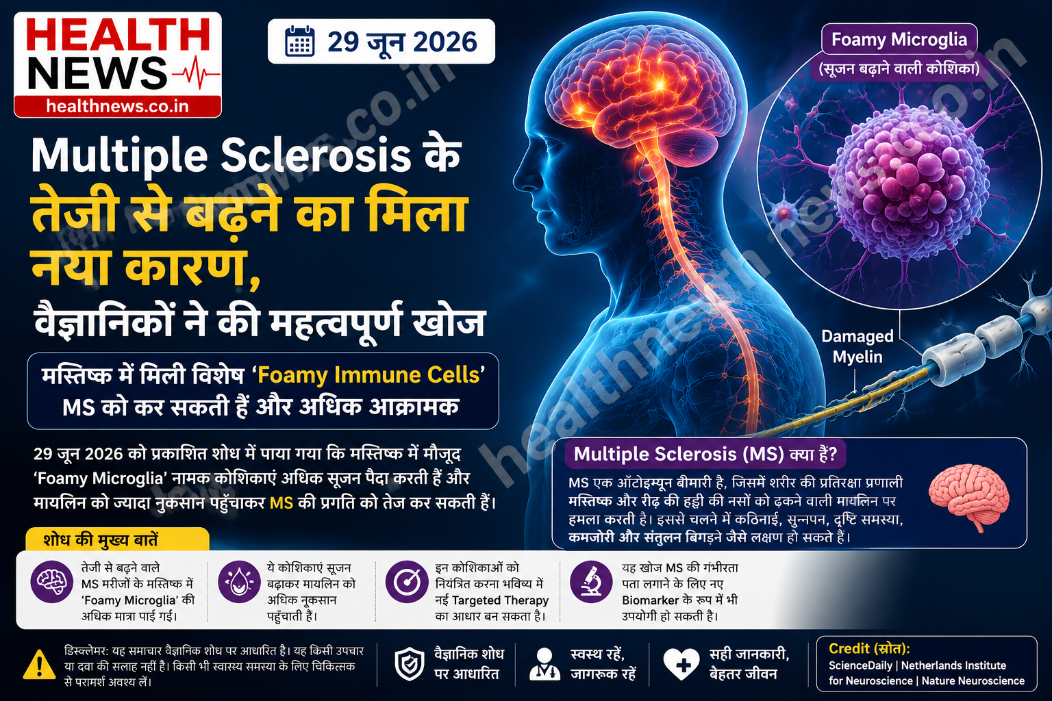 Multiple Sclerosis के तेजी से बढ़ने का मिला नया कारण, वैज्ञानिकों ने की महत्वपूर्ण खोज